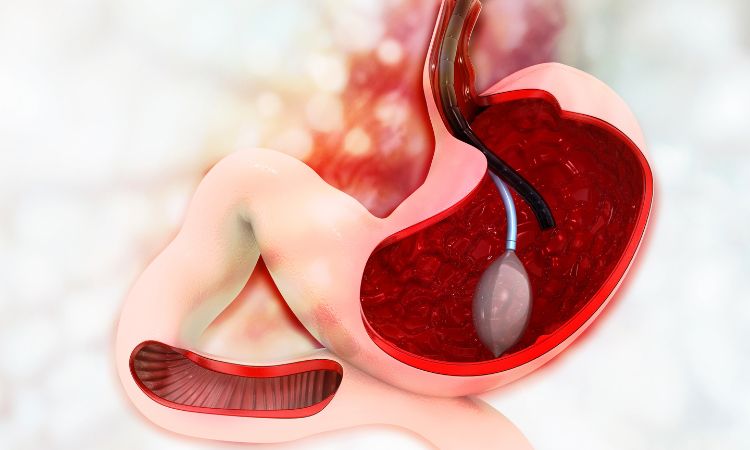 polyp dạ dày có nên cắt không